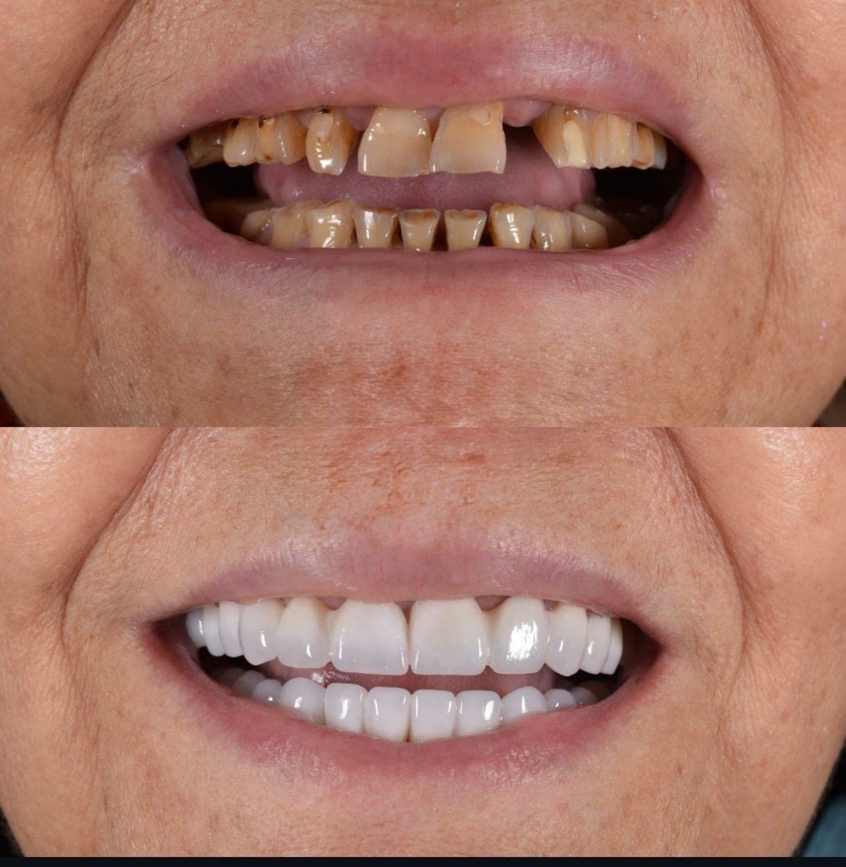 avant après implants dentaires en Roumanie résultat traitement complet