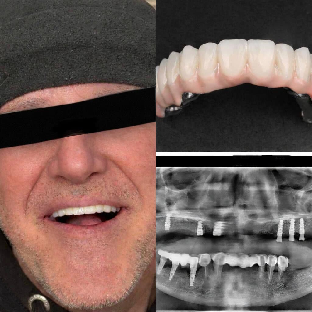 résultat implants dentaires avec radiographie et prothèse
