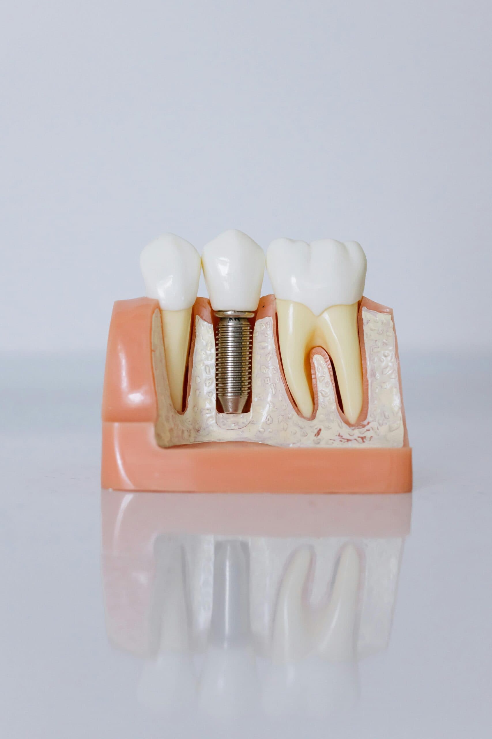 schéma implant dentaire  explication du traitement