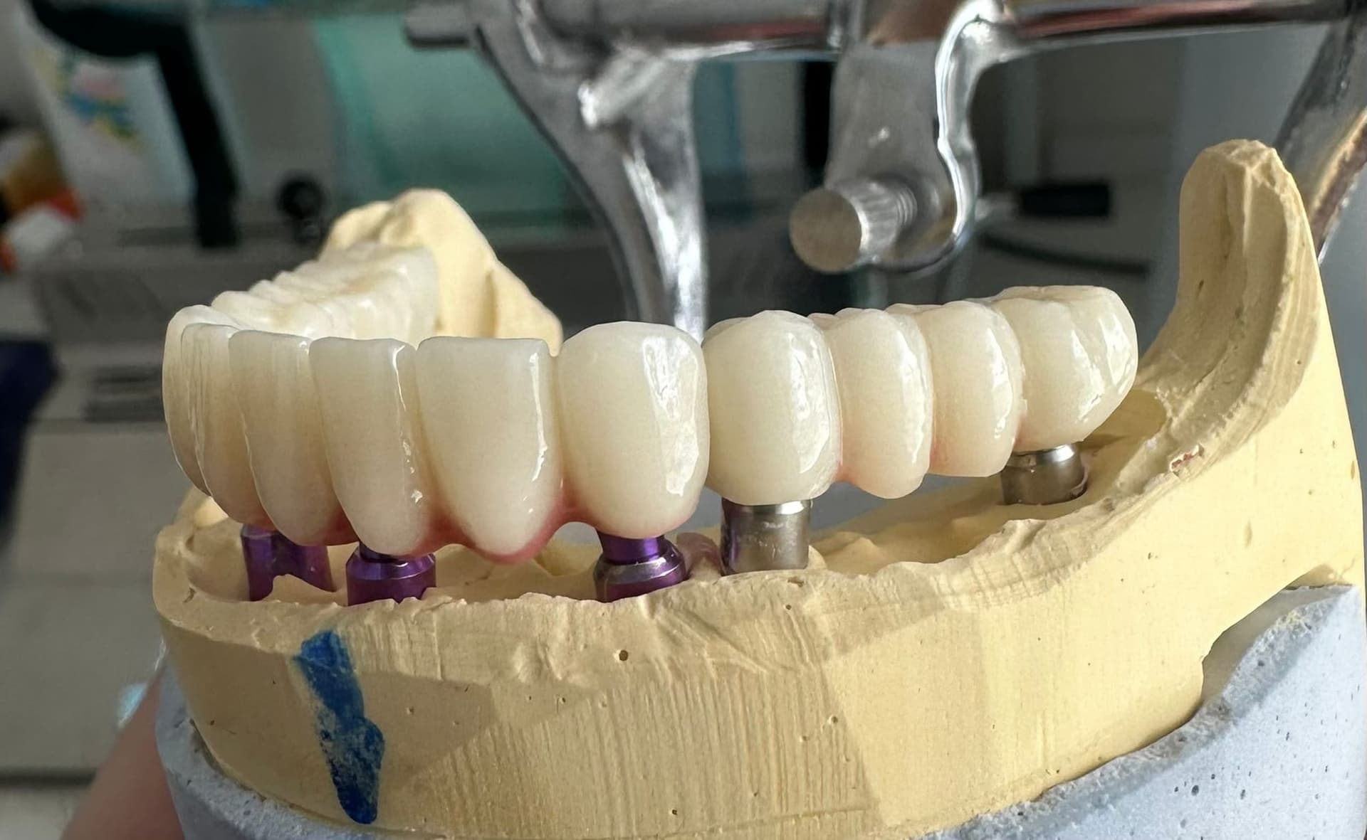 prothèse dentaire sur implants réalisée en Roumanie