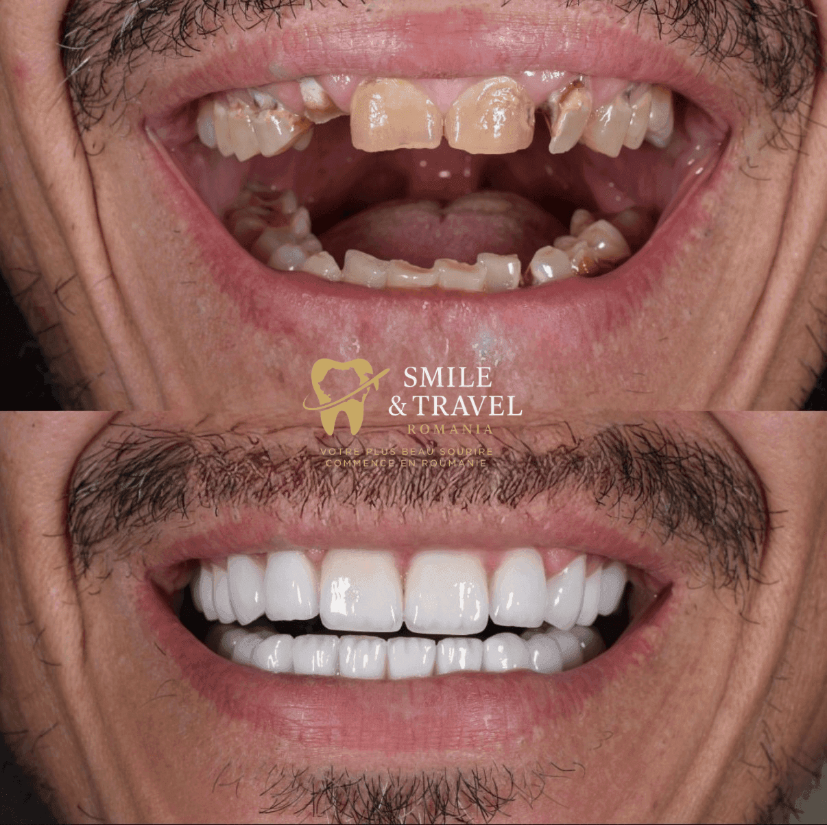 avant après soins dentaires Roumanie résultat patient Smile Travel