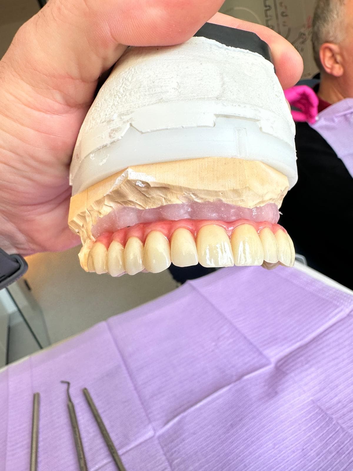 Prothèse complète fixée sur implants, présentée sur son modèle en plâtre au laboratoire