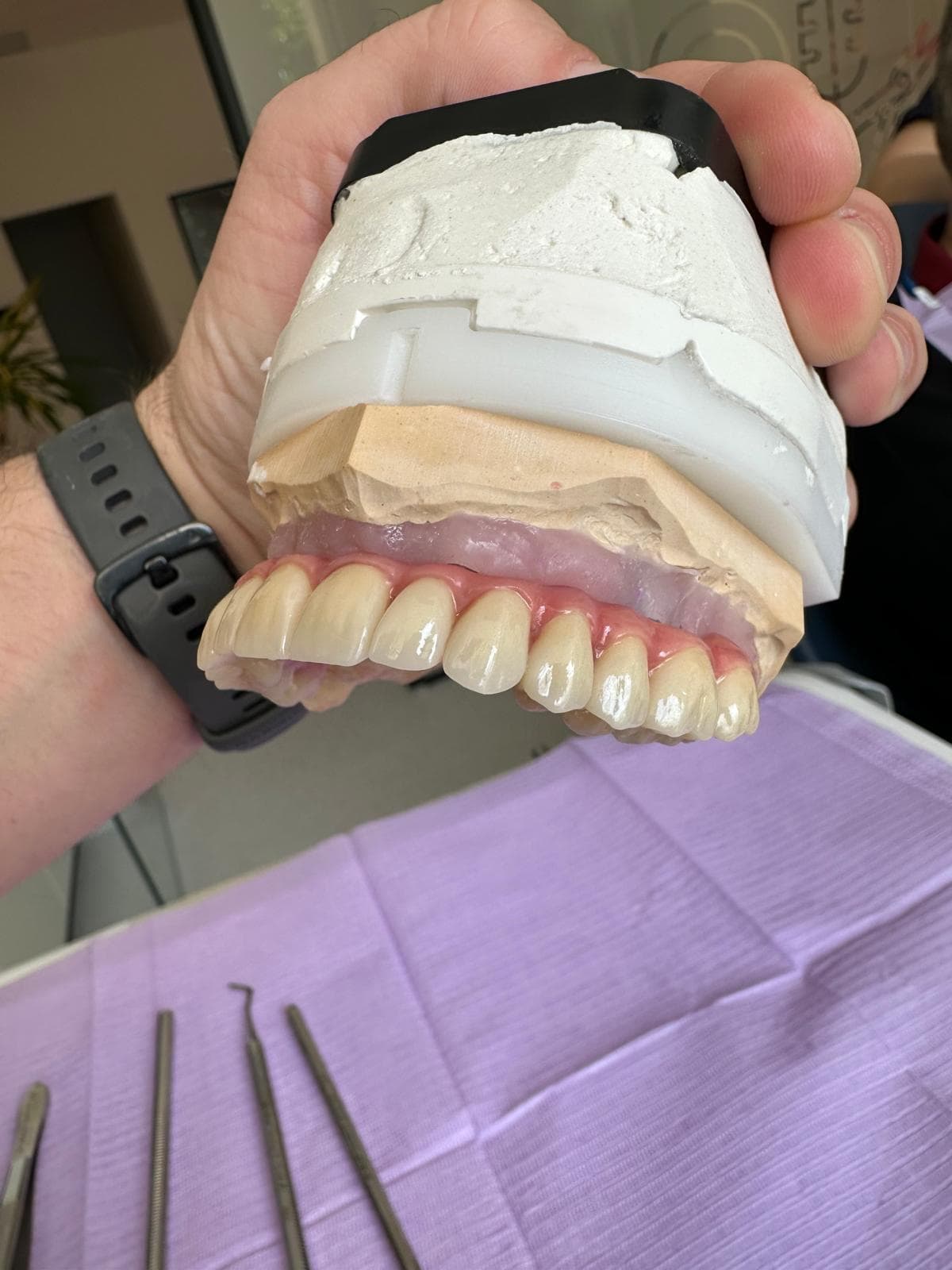 Prothèse complète en cours de finition au laboratoire, sur modèle en plâtre