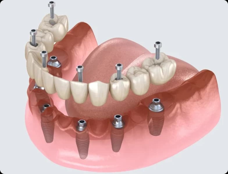 Prothèse complète fixée sur quatre implants
