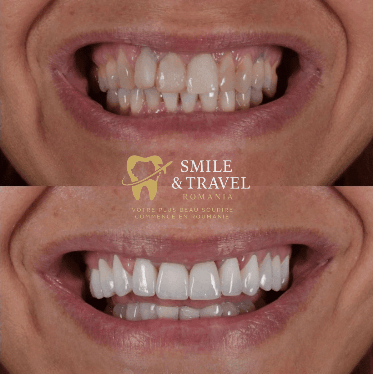 avant après couronnes dentaires Roumanie résultat patient Smile Travel Romania