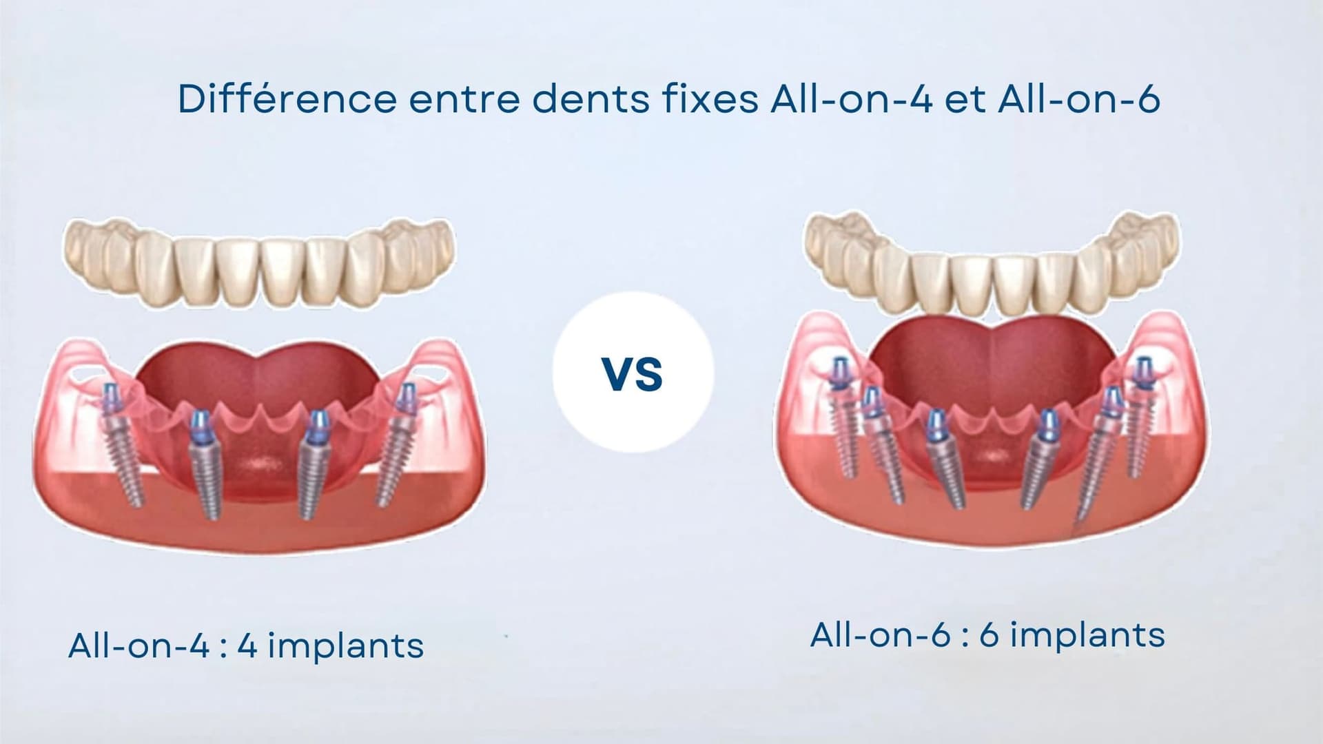 différence dents fixes all on 4 all on 6 implants dentaires