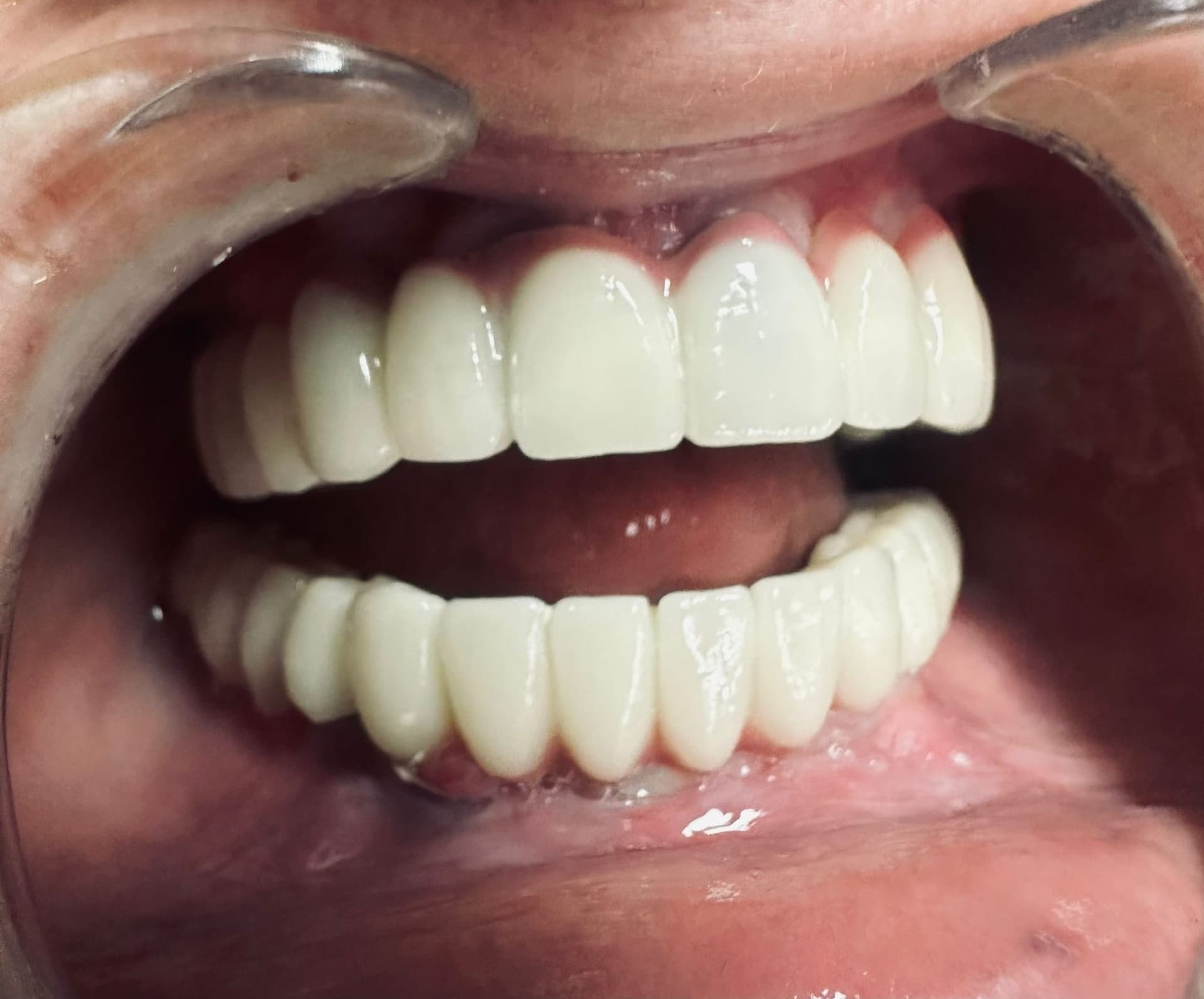 Combien coûtent vraiment des implants dentaires en Roumanie?