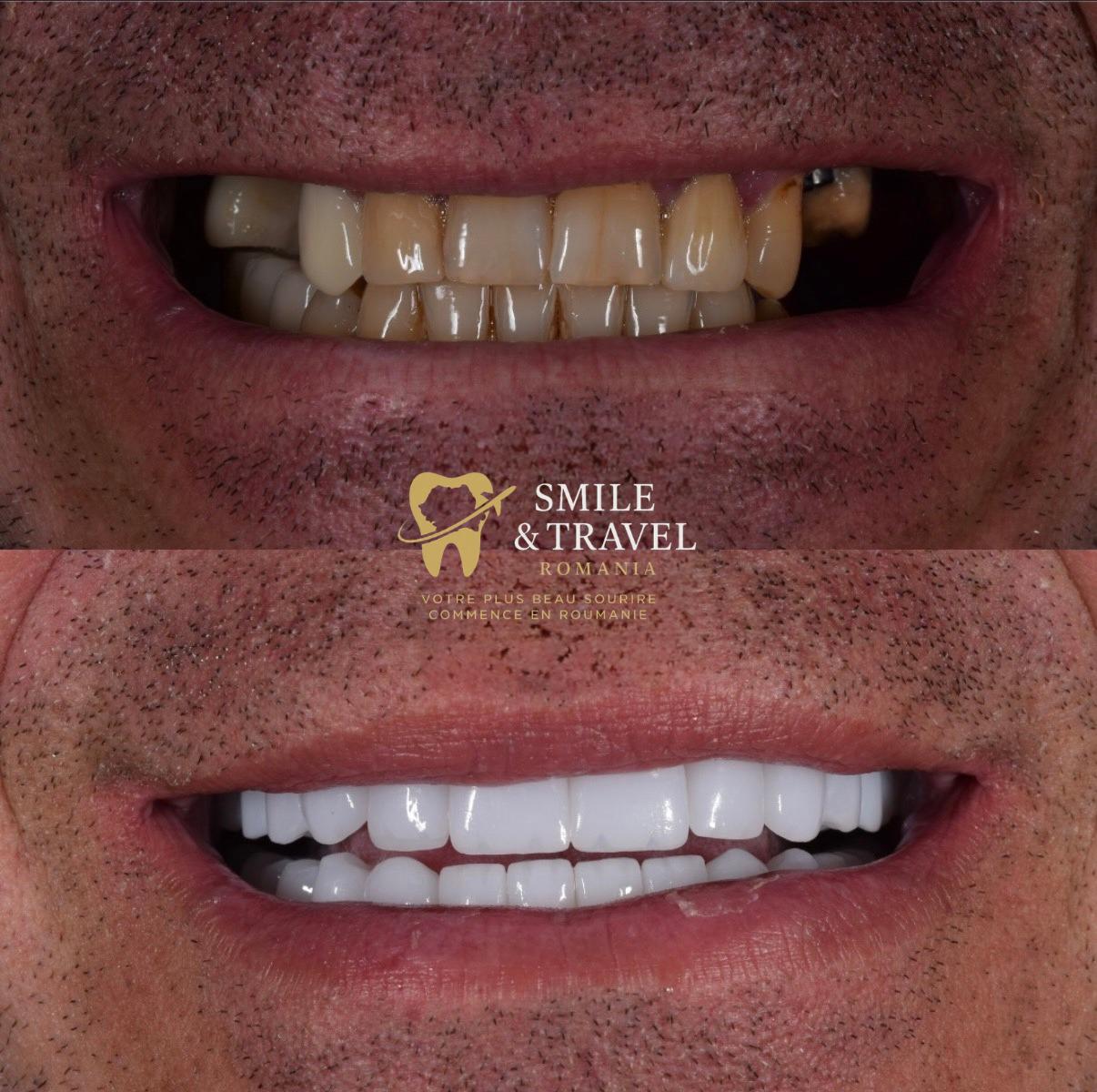 Implants - Patient A., 54 ans, Paris